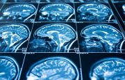 ADHD Brain Scan