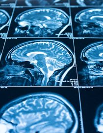 How Brain Scans May Change ADHD Diagnoses How Brain Scans May Change ADHD Diagnoses